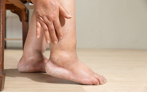 Am I a Candidate for Lymphedema Surgery