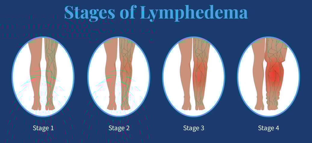 Stages of Lymphedema